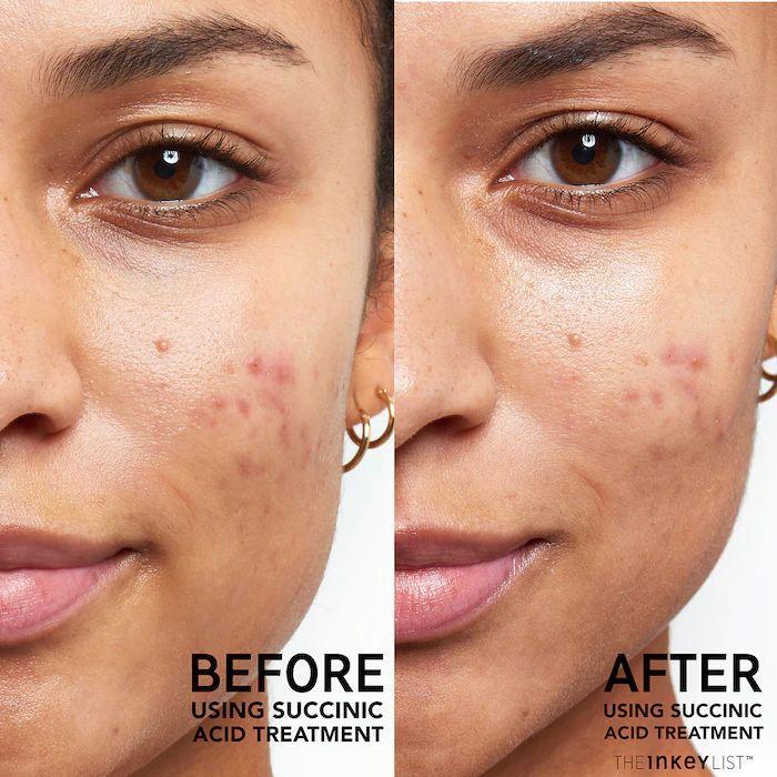 Succinic Acid Acne Treatment~ The Inkey List