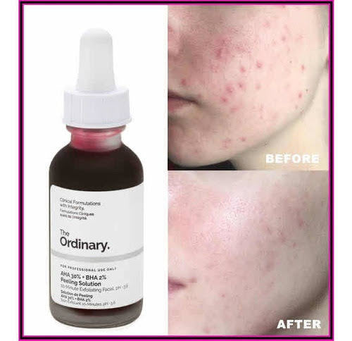 The Ordinary AHA 30% + BHA 2% Peeling Solution